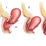 افتادگی مثانه