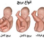 بریچ چیست
