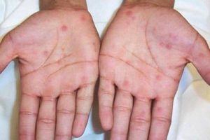 عفونت سیفلیس چیست و چگونه به وجود می آید؟