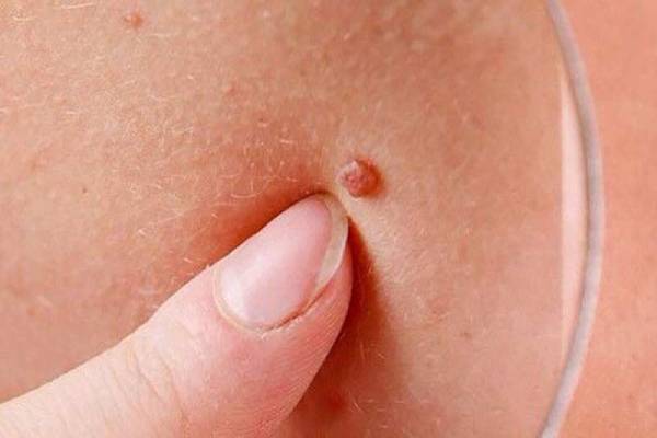 زگیل تناسلی