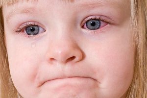 علت قرمزی اطراف چشم‌ کودک و چگونه می‌توان آن را از بین برد؟