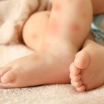 حساسیت نوزاد به شیر مادر