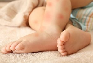 حساسیت نوزاد به شیر مادر