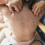 سندرم رایز کودکان