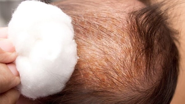 پوست ریزی سر نوزاد