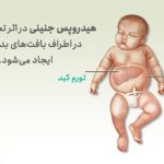 تشخیص و درمان هیدروپس جنینی