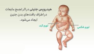 تشخیص و درمان هیدروپس جنینی