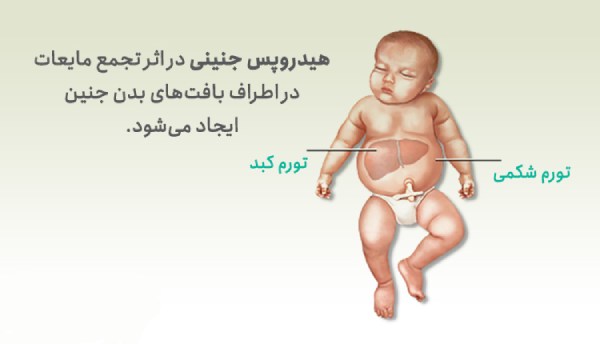 تشخیص و درمان هیدروپس جنینی