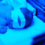 درمان زردی نوزاد