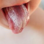 همه چیز در مورد برفک دهان نوزاد