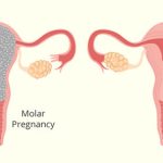 حاملگی مولار چیست؟ حاملگی مولار چیست؟