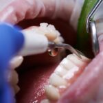 آمالگام دندانی: بهترین گزینه برای پرکردن دندان با دوام و مقرونبهصرفه آمالگام دندانی: بهترین گزینه برای پرکردن دندان با دوام و مقرونبهصرفه