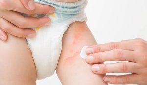 راهنمای تشخیص کِرمَک یا حساسیت پوستی نوزاد: علت قرمزی پوست چیست؟