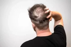 نوشیدنی‌های شیرین و تاثیر منفی آن‌ها بر ریزش مو: چرا باید احتیاط کنیم؟