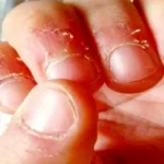 علت و درمان پوست‌پوست شدن اطراف ناخن: راهکارهایی مؤثر برای بهبود سلامت ناخن‌ها