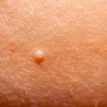 مولوسکوم کنتاژیوزوم در زنان چیست؟ مولوسکوم کنتاژیوزوم در زنان