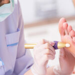 مراقبت بعد از سوزاندن میخچه