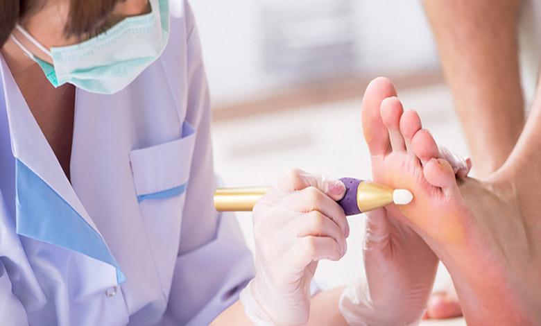 مراقبت بعد از سوزاندن میخچه