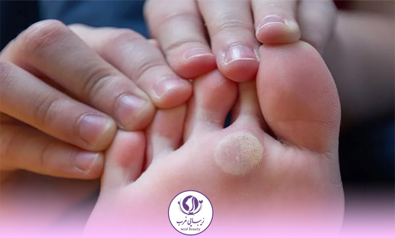 مراقبت‌های بعد از سوزاندن میخچه با لیزر