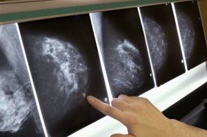 ارتباط تجمع اسیدهای صفراوی با افزایش احتمال متاستاز در سرطان سینه
